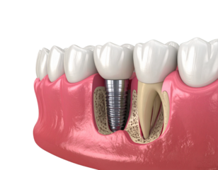 implant dişler detaylı şekilde 3 boyutlu vektör 