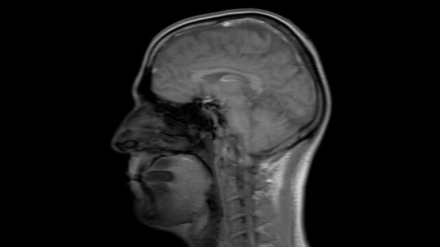 Human head X ray brain