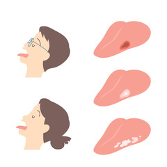 舌の症状と舌を出す男女の横顔