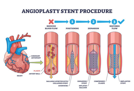 Angioplasty stent procedure shows heart, artery, and stent placement to restore blood flow, transparent background.