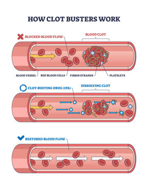 Clot busters work by dissolving blood clots in vessels, restoring blood flow, key objects, blood clot, drug, blood vessel, transparent background.