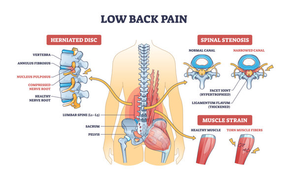 Low back pain diagram shows spine, herniated disc, spinal stenosis, and muscle strain with labeled anatomical structures, transparent background.