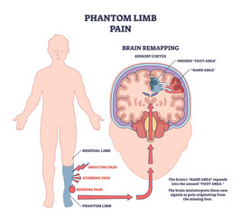 Obraz premium Phantom limb pain is shown with a human figure, brain diagram, and pain signals to illustrate brain remapping after limb loss, transparent background.