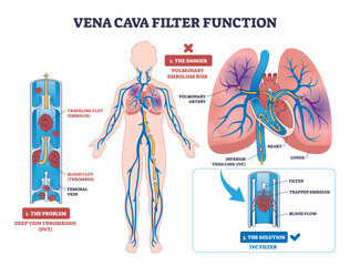 Vena cava filter diagram shows blood clot prevention in veins, highlighting filter, blood flow, and clot, transparent background.