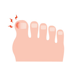 Ingrown Toenail on Foot. vector illustration