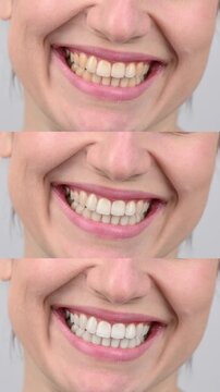 Caucasian woman smiling. Before and after teeth whitening.
