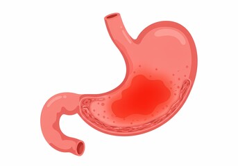 Fototapeta premium Medical illustration showing the human stomach with inflamed mucosal lining, depicting irritation and redness caused by excessive spicy food and increased acid secretion leading to gastritis symptoms.