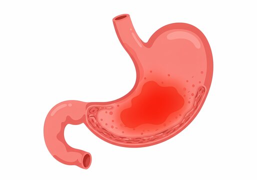Medical illustration showing the human stomach with inflamed mucosal lining, depicting irritation and redness caused by excessive spicy food and increased acid secretion leading to gastritis symptoms.