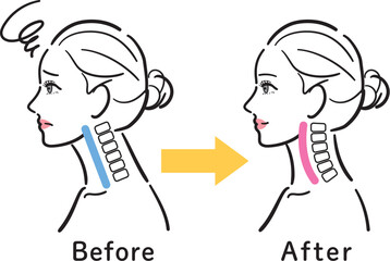 ストレートネックから正常な状態への変化イラスト（女性横顔・ビフォーアフター）