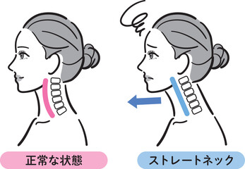 正常な状態とストレートネックの比較イラスト（女性横顔）