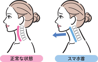 正常な状態とスマホ首の比較イラスト（女性横顔）