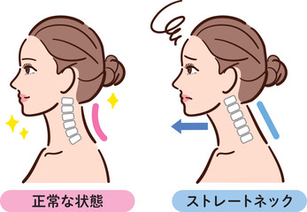 正しい姿勢とストレートネックの比較イラスト（女性横顔）