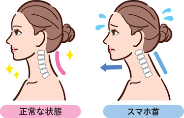 正しい姿勢とスマホ首の比較イラスト（女性横顔）