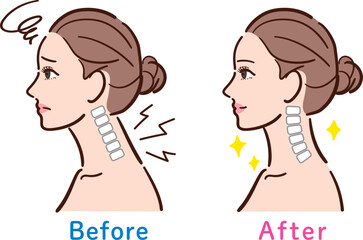 正常な状態とストレートネックの比較イラスト（女性横顔・Before After）