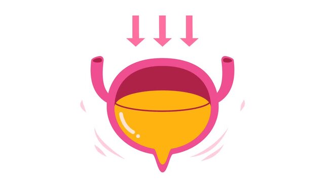 Human Urinary Bladder Disease and Infection Medical Illustration. Urology Health : Overactive Bladder (OAB) and Urinary Tract Inflammation Graphic Animation 