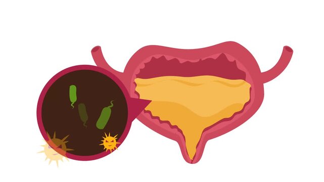 Human Urinary Bladder Disease and Infection Medical Illustration. Urology Health : Overactive Bladder (OAB) and Urinary Tract Inflammation Graphic Animation
