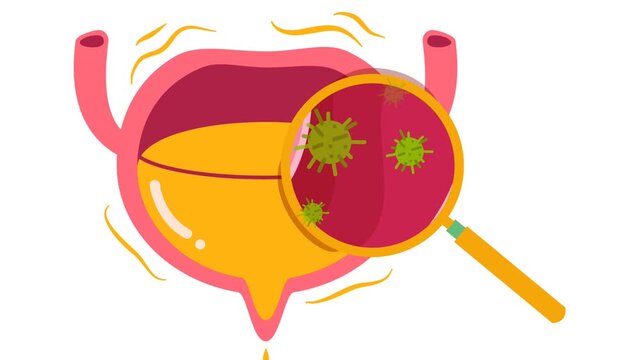 Human Urinary Bladder Disease and Infection Medical Illustration. Urology Health : Overactive Bladder (OAB) and Urinary Tract Inflammation Graphic Animation