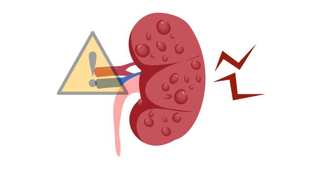 Polycystic kidney illustration animation. World kidney day	
