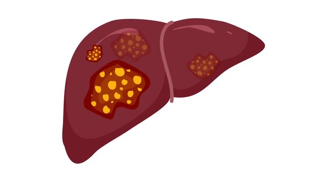 Liver cancer illustration animation. Lover disease 
