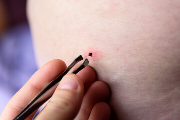 Removing an encephalitis tick with tweezers on a human body.