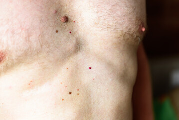 Fototapeta premium Lipomatosis or Dercum's disease (neurolipomatosis) on the man's abdomen. Foci of overgrown fatty tissue.