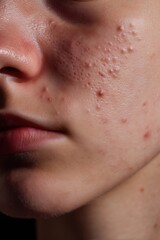 Fototapeta premium Close-up of skin displaying acne, large pores, and skin imperfections. Focus on texture and skin health conditions.