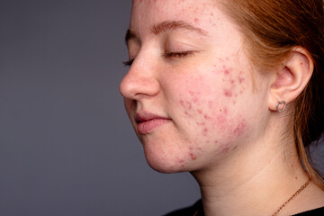 Obraz premium Acne. Skin texture background. Closeup acne pimple. Treatment for skin. Problem skincare. Pimples, pores, scars. Natural skin. Skin care concept. Acne treatment. Pimples on face. Acne and pimple.