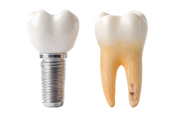 Modern dental implant contrasted with a natural tooth showing decay, highlighting oral health transformation and treatment options