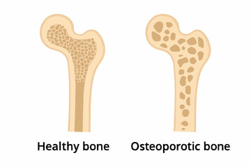 Comparison of Healthy and Osteoporotic Bone Structure Vector