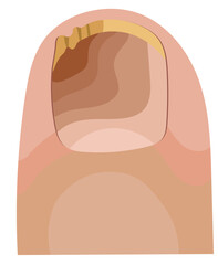 Toenail Fungus Infection Condition Illustration Isolated on White Background
