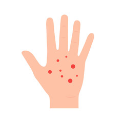Obraz premium Hand with Red Spots A Sign of Potential Skin Condition.