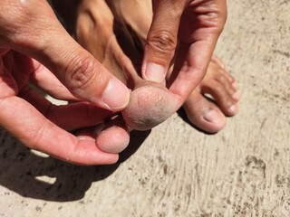 Close up of cracked toe skin. The cause of cracked feet is generally due to dry skin or loss of moisture. 