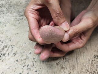 Close up of cracked toe skin. The cause of cracked feet is generally due to dry skin or loss of moisture. 