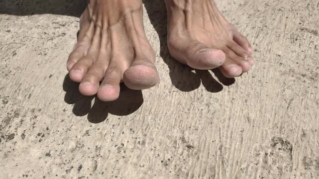 Close up of cracked toe skin. The cause of cracked feet is generally due to dry skin or loss of moisture. 