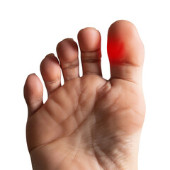 Close-up of a painful red big toe on a human foot, showing inflammation from an injury or medical condition like gout or arthritis