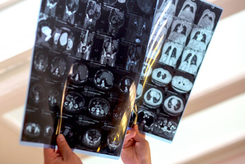 Hands holding and examining medical MRI or CT scan images of human organs in bright daylight. Concept of healthcare diagnostics, radiology, hospital examination, and medical research.