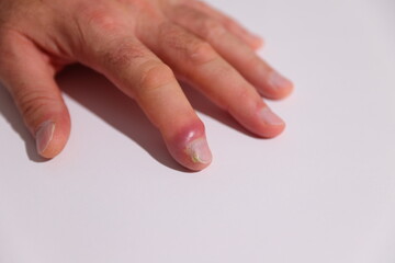 Nail inflammation, pus under skin, infection treatment