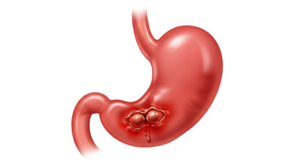 Isolated Human Stomach with Ulcers, Medical Illustration Showing Pain and Suffering Anatomy