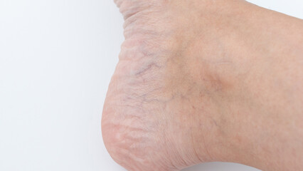 Fototapeta premium Varicose veins and spider veins visible on a leg, showcasing skin texture and condition, emphasizing the need for effective treatment options
