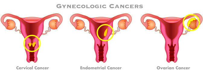 Gynecologic cancers. Endometrial, ovarian, cervical illness. Woman, female reproductive system disease. Vector illustration