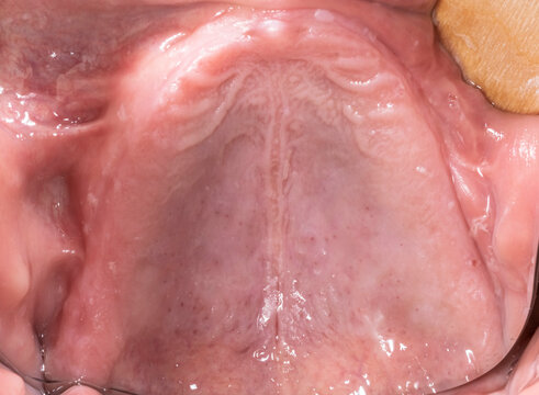 Close-up intraoral mirror view from below showing an edentulous and atrophied maxillary arch in an elderly patient, with lips and cheeks retracted using a wooden tongue depressor.