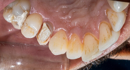Intraoral buccal view of the maxillary arch showing a destroyed first premolar crown and a molar restored with white temporary cement fillings.