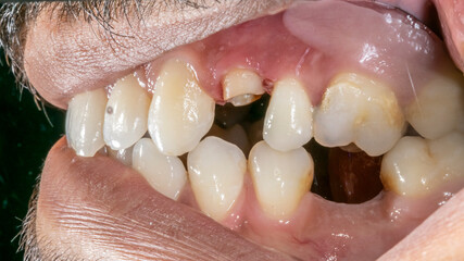 Intraoral lateral buccal view of a dentistry patient case. Maxillary and mandibular arches in biting teeth occlusion showing first premolar crown destroyed and prepared a prosthetic restoration.