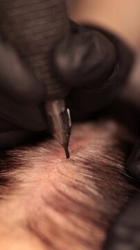 Process of scalp micropigmentation (SMP) for restoring the look of a fuller head of hair and defining a natural hairline