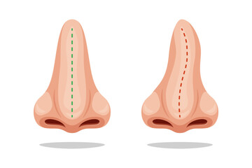 Illustration curve and correct nose, correction nasal curvature. Nose before and after.