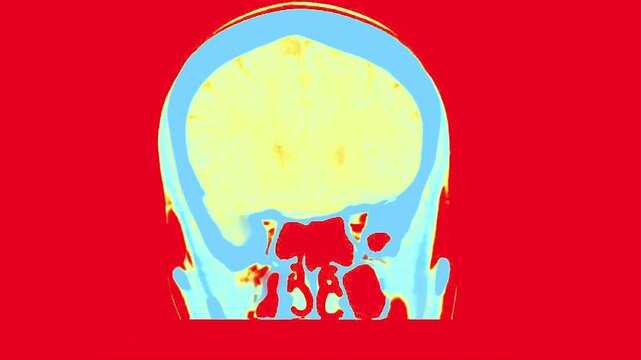 MRI Scan of the Brain Highlighting Enhanced Structural Features with Color-Coded Imaging for Detailed Visualization of Intricate Anatomical Structures in Red and Blue