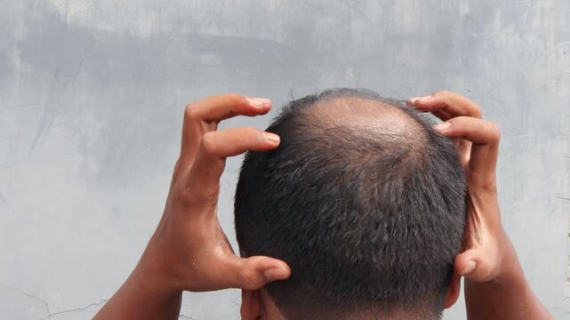 Asian Man with hair loss problems closeup,isolated. Alopecia balding hairs on man scalp. Human alopecia or hair loss-person hand pointing his bald head. Scratching his head. Baldness.Depression,stress