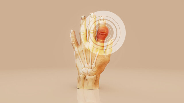 Conceptual 3D Animation of Gout in Finger Joint and Inflammation