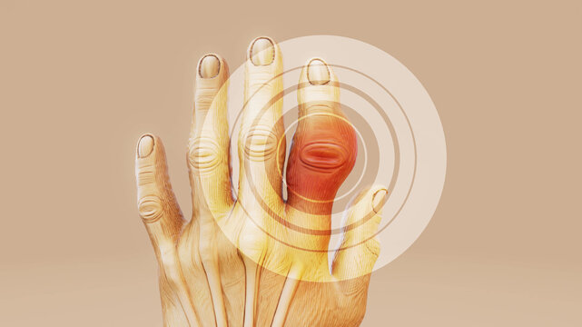 Conceptual 3D Animation of Gout in Finger Joint and Inflammation