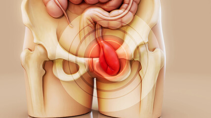 Conceptual 3D illustration of a human hernia